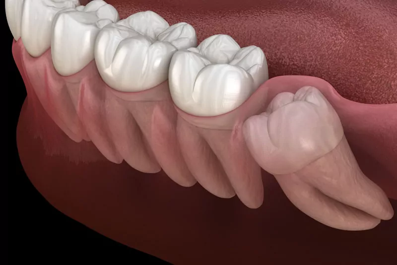 Wisdom Tooth Removal